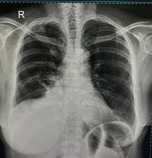 Image result for Pleural Tuberculosis
