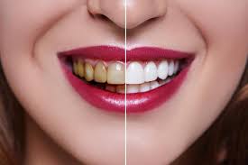 Dental Deep Cleanings