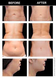When Is The Perfect Time For Body Contouring? - Just Melt Med Spa