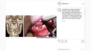 Buatmu yang belum tahu, silakan baca, ya! Vape Meledak Saat Digunakan Rahang Patah Hingga Beberapa Gigi Terlepas