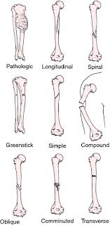 Oblique Fracture Medical Dictionary Medical Coding Medical Knowledge