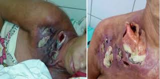 It may be difficult to delineate the prevalence rate of this condition as it is often confused with ida and is usually a. Fournier S Gangrene Of The Shoulder Girdle Intechopen