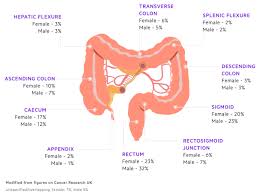 A persistent change in your bowel habits, including diarrhea or constipation or a change in the consistency of your stool rectal bleeding or blood in your stool persistent abdominal discomfort, such as cramps, gas or pain Pulsenotes Colorectal Cancer Notes