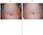 Stomach Waxing Before And After