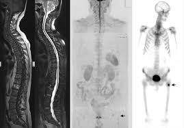 Bones are the most common site of hematogenous metastases of prostate cancer. Therapy Monitoring Of Skeletal Metastases With Whole Body Diffusion Mri Padhani 2014 Journal Of Magnetic Resonance Imaging Wiley Online Library