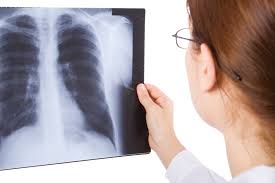 Image result for Acute Bronchitis