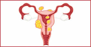 In fact, ketosis may offer some real benefits for women — especially those who suffer from pcos, endometriosis, and uterine fibroids  * . Large Uterine Fibroid Symptoms Causes Test And Treatment