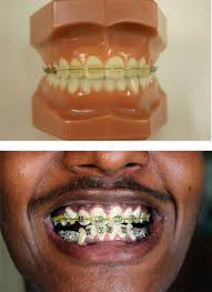 You can quickly formulate your own teeth whitening paste at home and use it to get rid of brace glue. Orthodontic Bracket An Overview Sciencedirect Topics