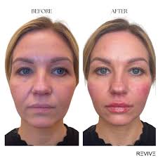 Achieve sculpted elegance with expert artistry: Cheek & Lip Filler  Transformation ✨ Our client desired a subtle enhancement to her natural  beauty, seeking both facial definition and a touch of youthful volume.