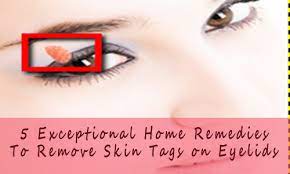 5 Most Preferable Home Remedies To Remove Skin Tags On Eyelids Skin Tag Removal Skin Tags On Face Skin Tag On Eyelid