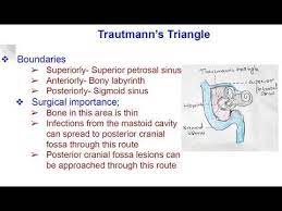 It is located between the sigmoid sinus and the middle fossa dura plate. Trautmann S Triangle Youtube