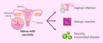 Image result for Friable Cervix