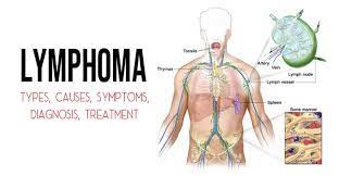 Read about treatment options and how lymphoma in children and adults differs. Lymphoma Types Causes Symptoms Diagnosis Treatment