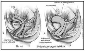 Müllerian agenesis is caused by embryologic underdevelopment of the müllerian duct, with resultant agenesis or atresia of the vagina, uterus, or both. Diagram Showing A The Normal Development Of The Female Reproductive Download Scientific Diagram