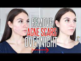 It is also a great way to naturally moisturize your skin and prevent it from producing too much they are usually caused by picking at a blemish and take much longer to heal. How To Get Rid Of Acne Scars Overnight Youtube