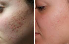 Get clear skin with Acne scar treatment at Dream Derma Clinic