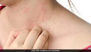 Rosewater is known for reducing redness and calming irritated skin. 5 Natural Remedies To Get Rid Of Rosacea Skin Redness Ndtv Food