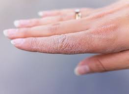 Image result for dyshidrosis