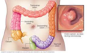 The tumor had been diagnosed during what i thought would be a routine colonoscopy. Colon Cancer Symptoms And Causes Mayo Clinic