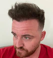 Can You Undergo a Hair Transplant With Long Hair?