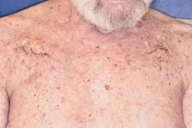 The rf fields around the tattoo device could possibly interfere with the icd or pacemaker also with a different set of severe problems. After Heart Surgery Keyword Search Science Photo Library
