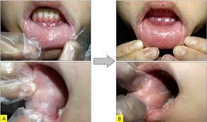 Image result for Leukoedema