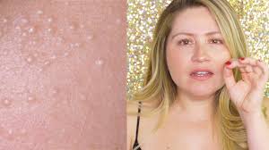 Small bumps on your face can be hard to identify. How To Get Rid Of Milia Hard White Bumps Youtube