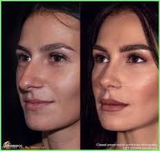Plastic Surgery Gone Wrong Before After Plastic Surgery Gone Wrong Nose Surgery Rhinoplasty Rhinoplasty Surgery