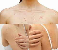 Kita boleh gila dan murung bila dua benda ini terjadi pada setiap perempuan. Cara Ampuh Singkirkan Jerawat Badan Biar Kulit Tubuhmu Makin Mulus