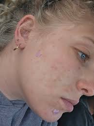 How to improve skin issues caused by IUD?