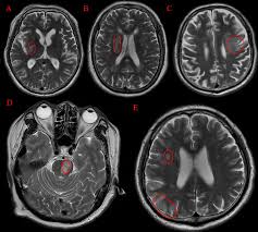 Image result for Brain Lesion