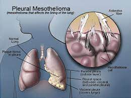 There are a number of different treatments doctors recommend. Malignant Pleural Mesothelioma