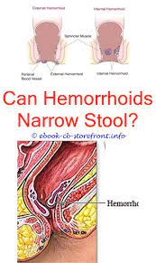 12 Majestic Hemorrhoid Symptoms Health Ideas Hemorrhoids Treatment Bleeding Hemorrhoids Cure For Hemorrhoids