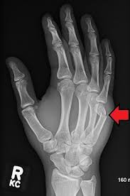 In this type of fracture, the ligament or the tendon pulls away from the bone it is attached to impaction fracture i have an avulsion fracture in my index finger knuckle on my dominant hand. Boxer S Fracture Wikipedia