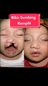 Tidak hanya dengan satu kali operasi untuk bisa mendapatkan bibir dan  hidung yang ideal. Pada proses penyembuhannya pun tetap terlihat adanya  bekas operasi walaupun sedikit yang tertinggal di mulut. ...