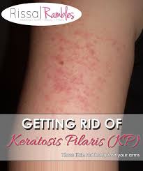 Rissa Rambles Com Getting Rid Of Keratosis Pilaris Kp Keratosis Pilaris Beauty Remedies Diy Health And Beauty Tips