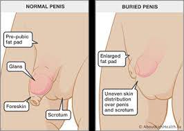 Pearly penile papules and penile warts. Buried Penis In Children