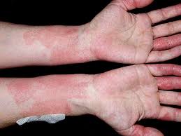 Image result for dermatitis contacta allergica
