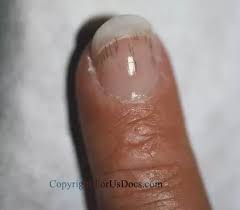 We did not find results for: What Is This Black Line On My Thumb Nail Quora