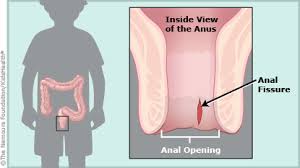 Safe & gentle without harmful additives. A To Z Anal Fissure For Parents Primary Children S Hospital