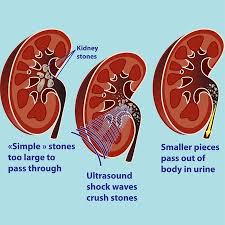Kidney Stones Health Navigator Nz