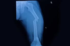 Maybe you would like to learn more about one of these? Los Riesgos Que Representa Una Fractura De Femur Nutricioni