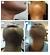 Dark Skin Black Woman Laser Hair Removal
