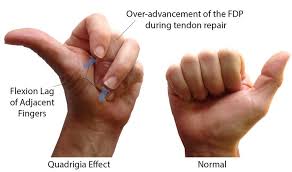 The hip flexors are several muscles that bring your legs and trunk together in a flexion movement. Quadriga Effect Hand Orthobullets