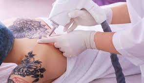 This article covered them all from home tattoo removal to natural tattoo removal methods in lemmon juice, mixed with salt is a great way to make your tattoo lighter. What Is The Best Method For Tattoo Removal Fresh Skin Canvas