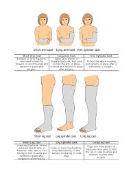 Image result for Short Arm Cast