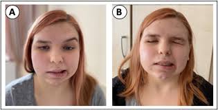 Bell's palsy following COVID-19 vaccination with high CSF antibody response 