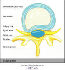 A 'slipped' (prolapsed) disc often causes sudden, severe lower back pain. University Orthopedics Herniated Disc Providence Rhode Island