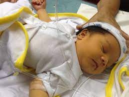 Penyakit kuning pada bayi atau jaundice pada bayi yang baru lahir boleh dikatakan biasa tapi menjadi luar biasa apabila kuningnya tidak hilang melebihi 10 hari.bagi pertama kali yang bergelar ibu bapa,situasi ini menjadikan si ibu dan bapa bimbang terhadap kesihatan permata hati. Mari Mengenal Penyakit Kuning Pada Bayi Prosehat