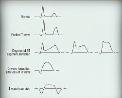 Image result for ST Elevation